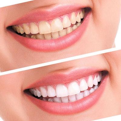 Beautiful Smile Teeth Whitening Kit